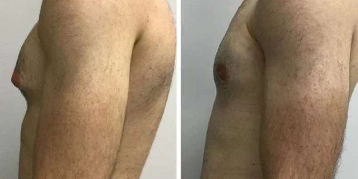 Best Gynecomastia Surgeon in Dubai with a Focus on Natural Results
