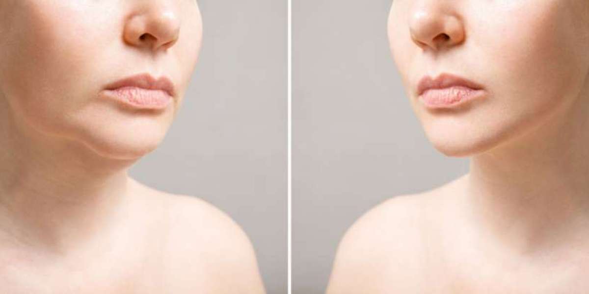 Advanced Techniques for Double Chin Liposuction in Islamabad