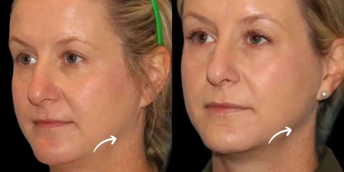 Skin Cell Activation with Sculptra Fillers by Best Doctors in Dubai