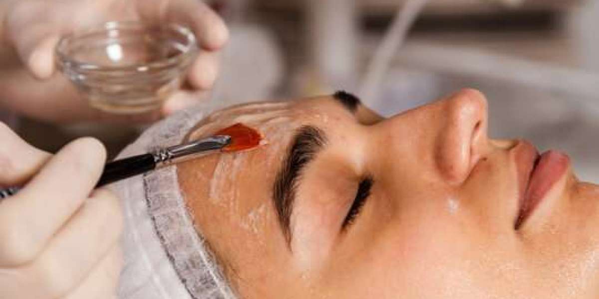 Top 5 Types of Chemical Peels Available in Islamabad