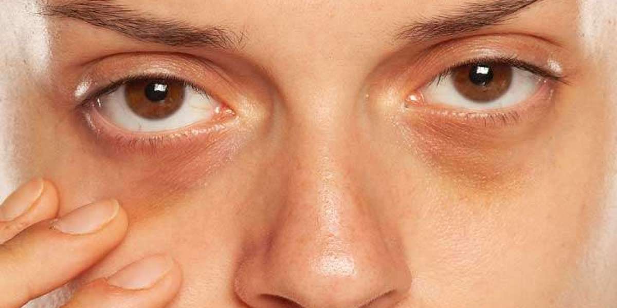 Dark Circles Therapy Guide Riyadh