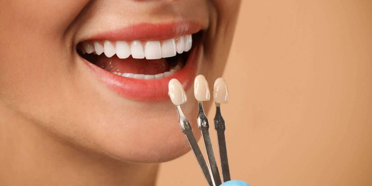 Improving Your Smile Aesthetics with Dental Veneers Treatment in Badlapur
