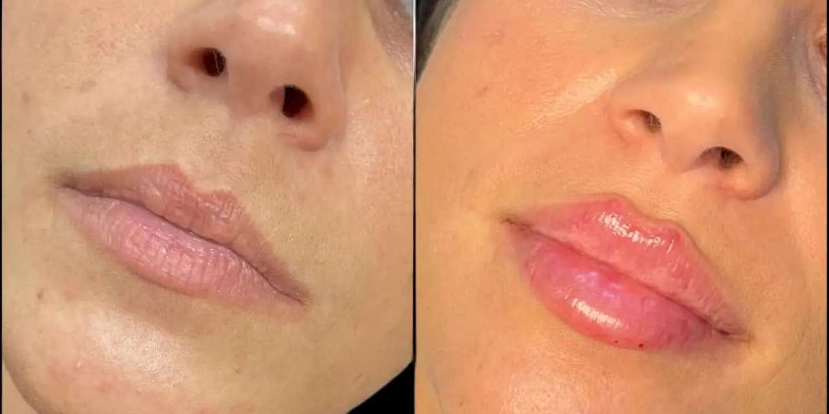 Dermal Fillers for Face Enhancement by Best Doctors in Dubai