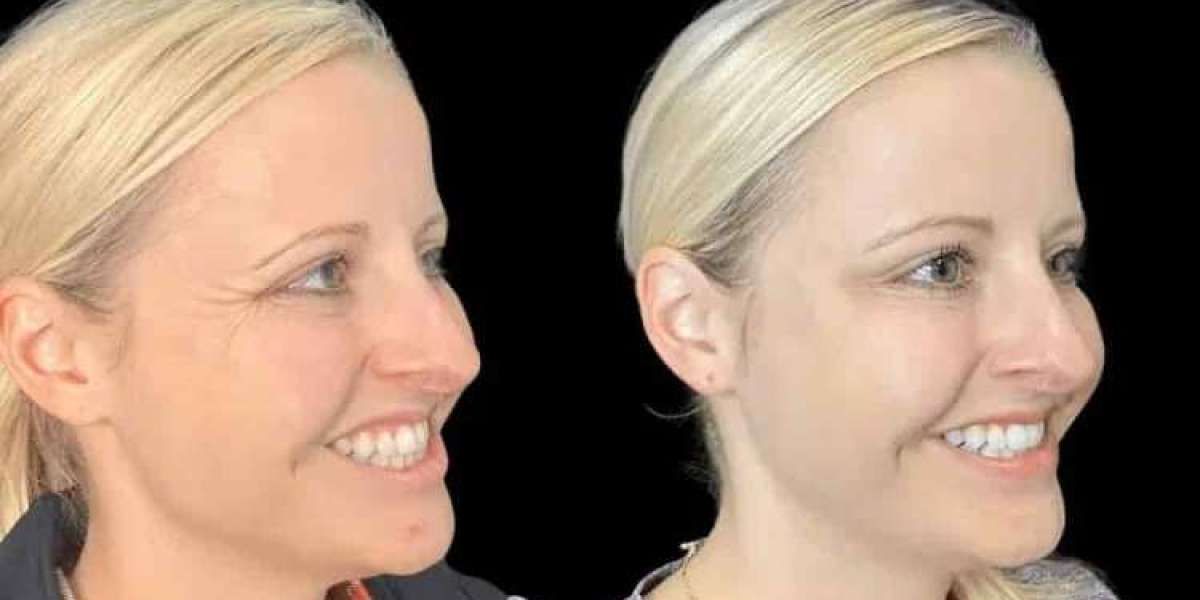Botox in Jeddah Smooth Wrinkles and Restore Youthful Skin
