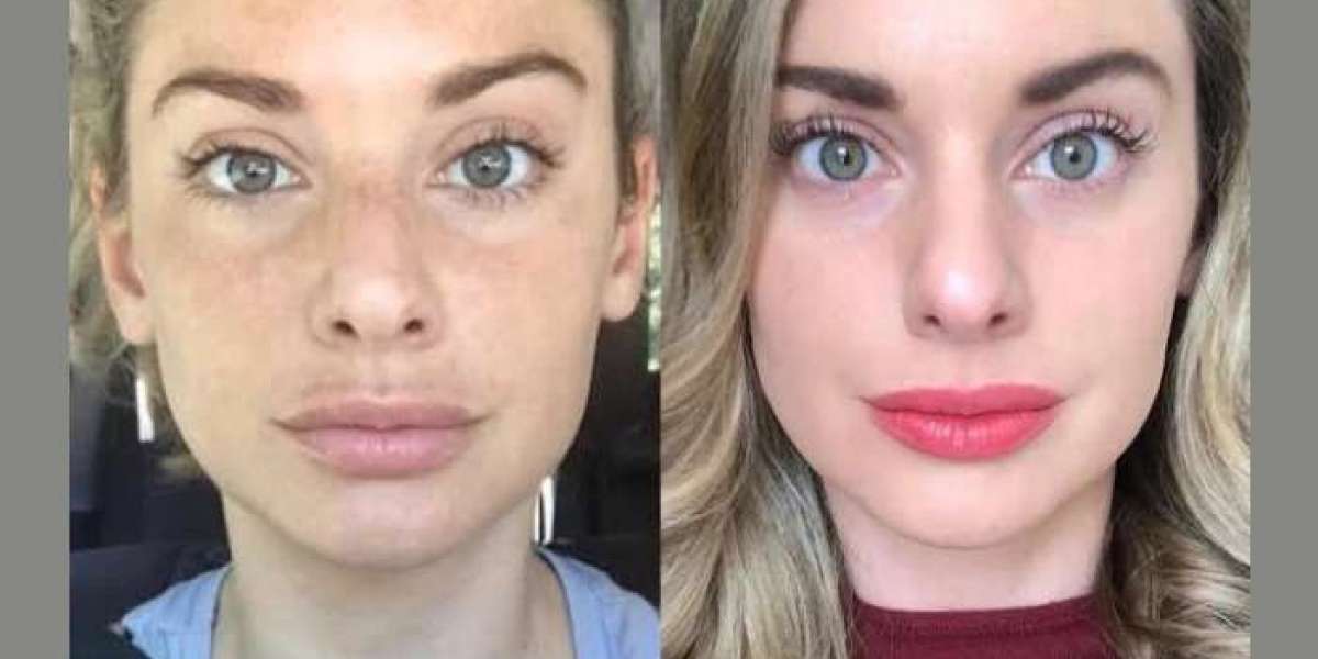 Skin Therapy: Radiofrequency Microneedling by Best Aesthetic Clinic in Dubai
