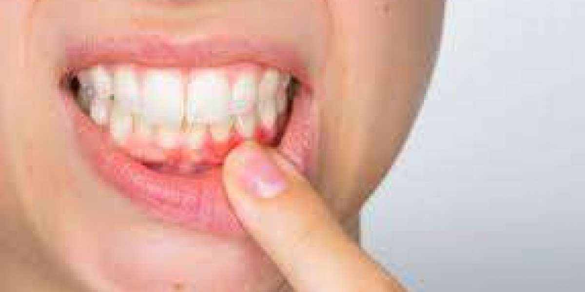 What Causes Bleeding Gums and How Can Treatment Help?