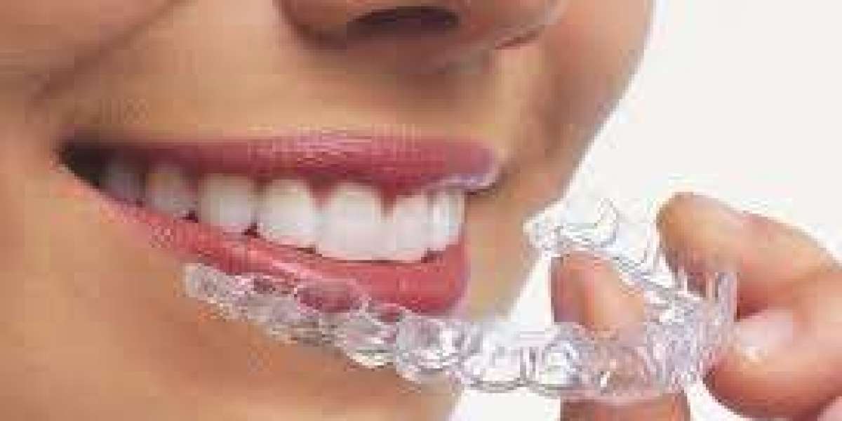 Why Aligners In Dubai Are Preferred Over Traditional Braces Today