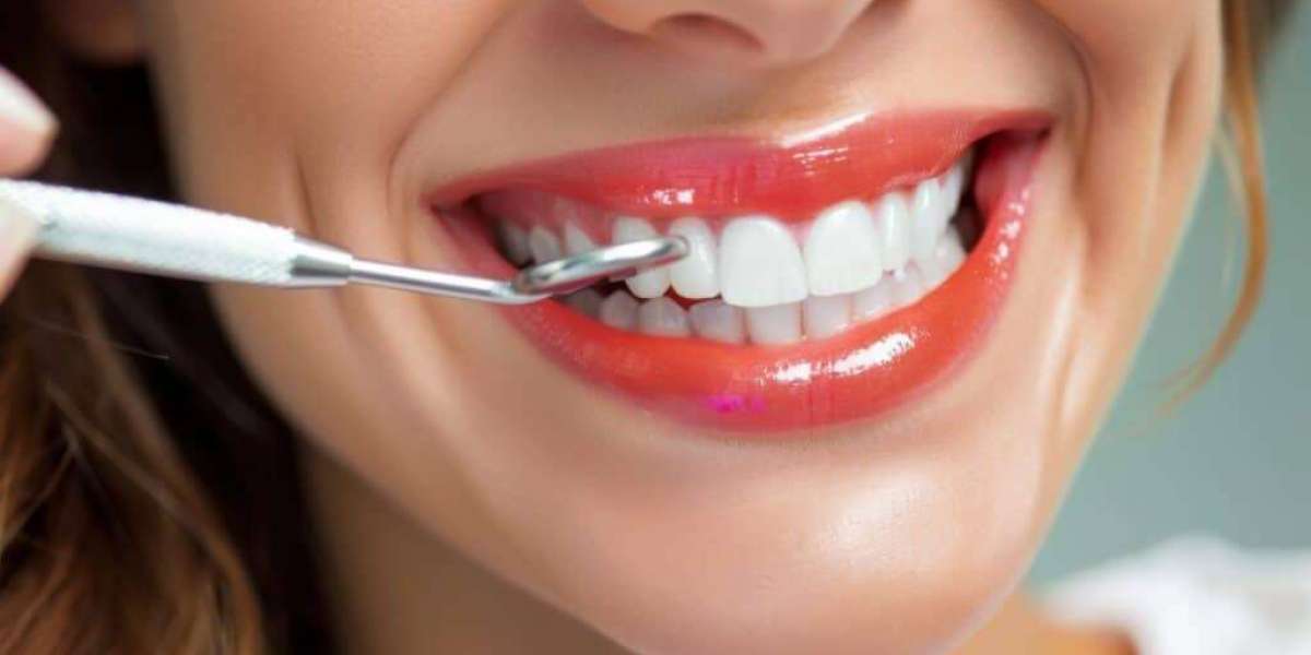 Veneer in Dubai for a Bright Smile