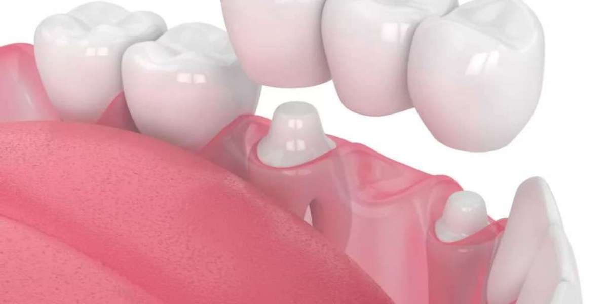 Tooth Crown Dubai Procedure Explained in Detail