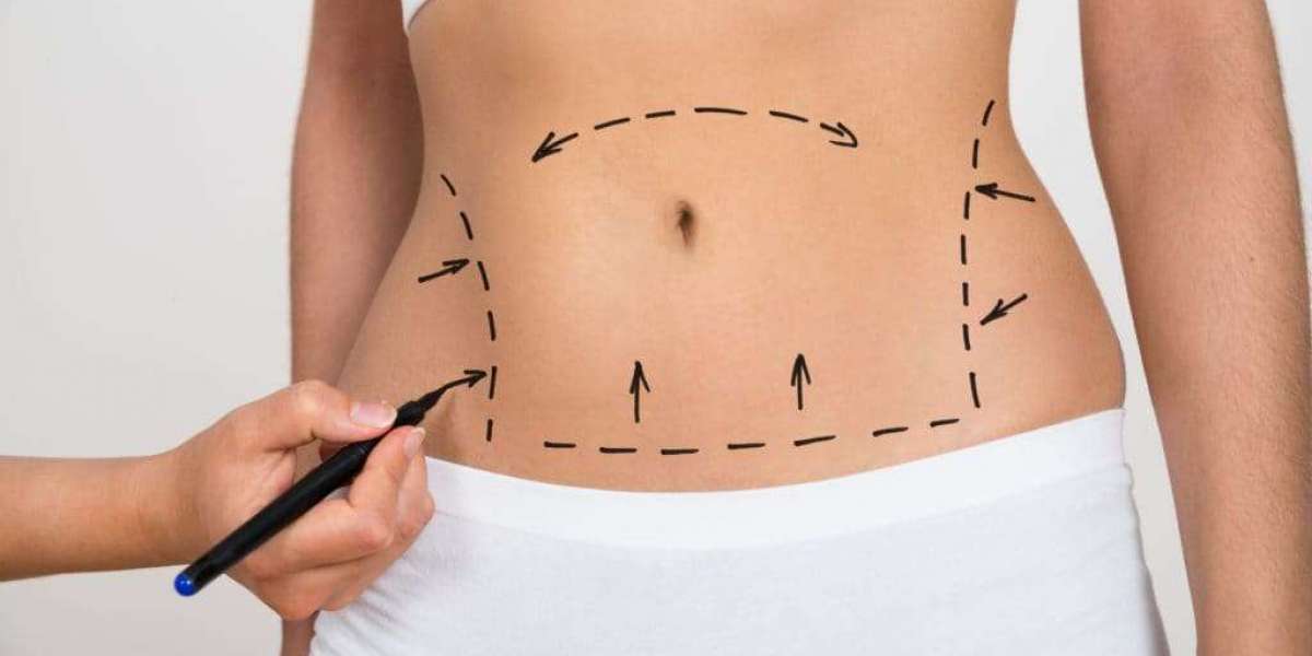 Top Clinics for Safe and Effective Abdominoplasty in Dubai