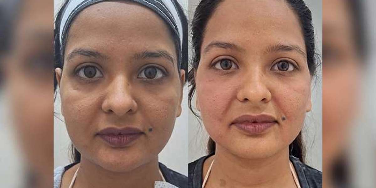 Face Lifting in Delhi – Advanced Solutions for Youthful and Firm Skin