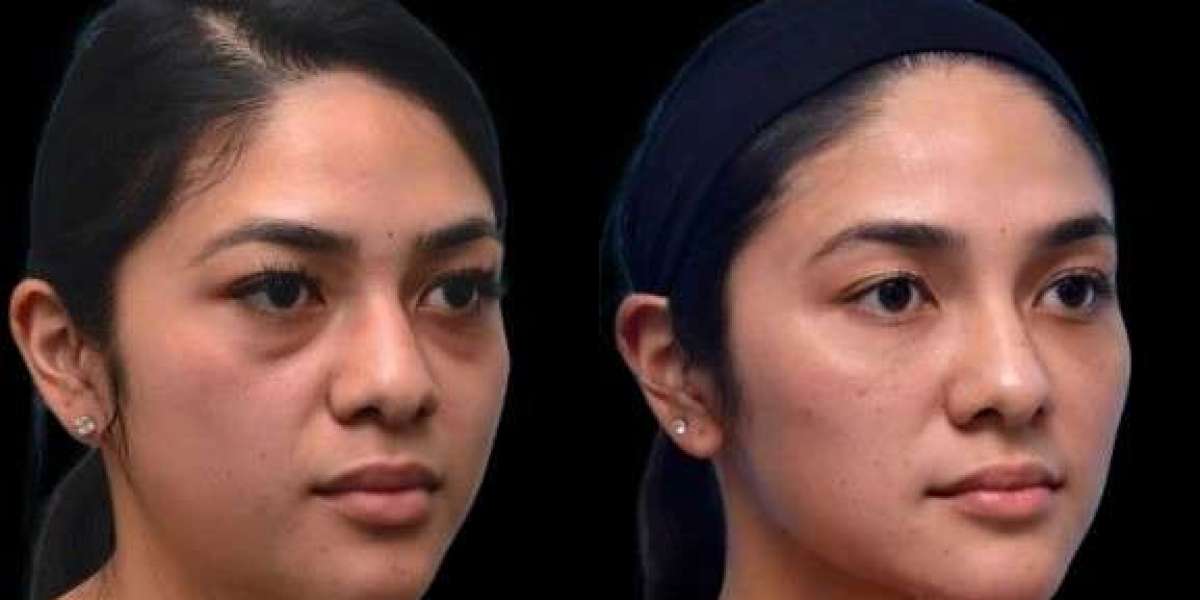 Top skincare tips recommended by Best Doctors in Dubai for Dark Circles
