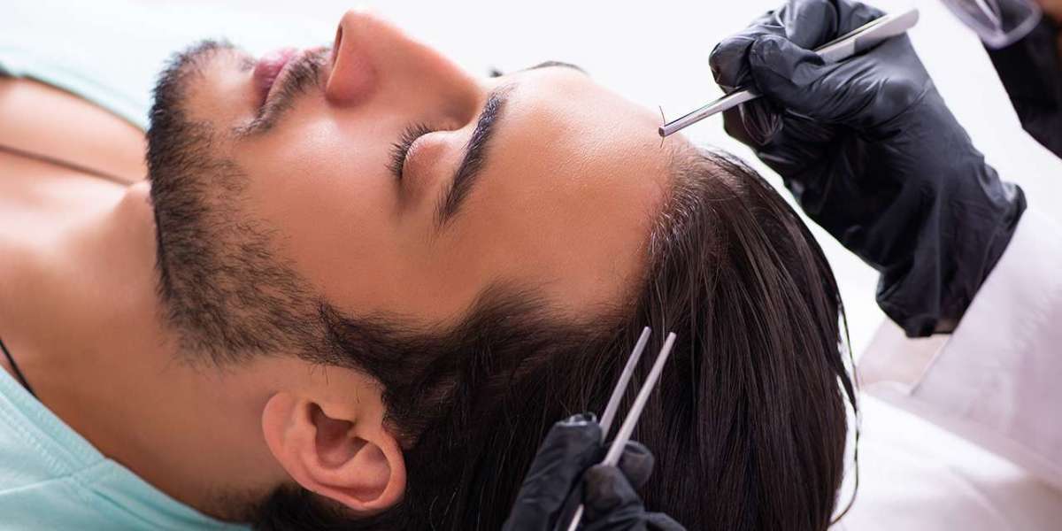 Can Hair Transplant in Dubai improve hair density?