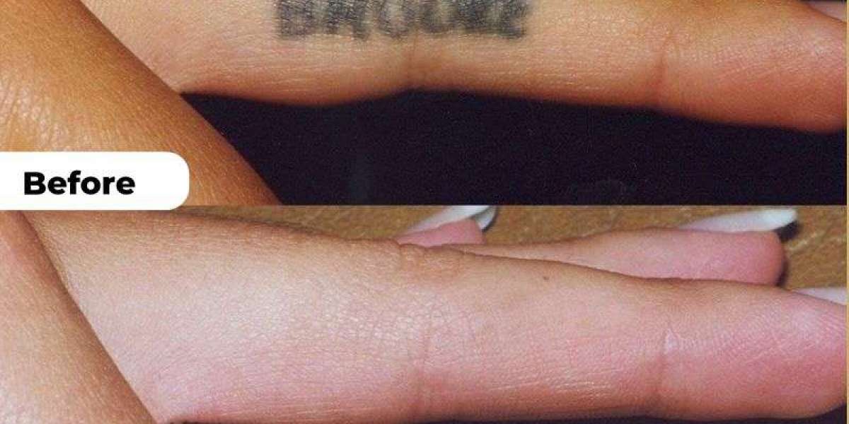 Complete Guide to Laser Tattoo Removal in Islamabad