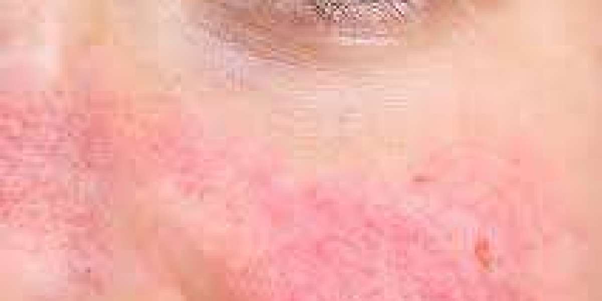 How Rosacea Treatment in Islamabad is Transforming Skin Care