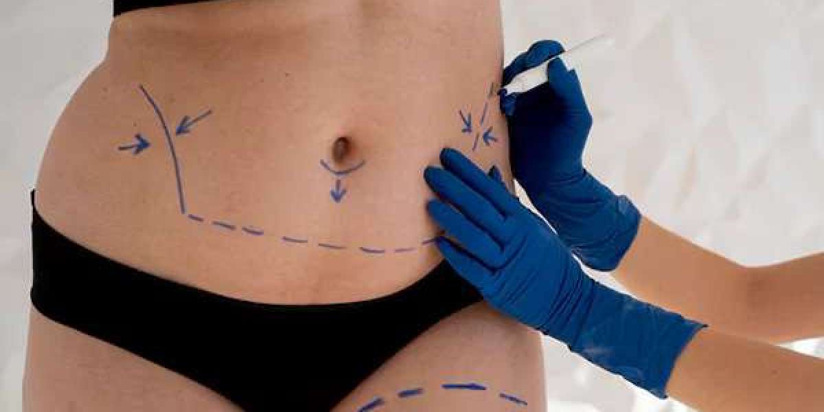 Liposuction Surgery in Dubai: Cost, Procedure, and Results
