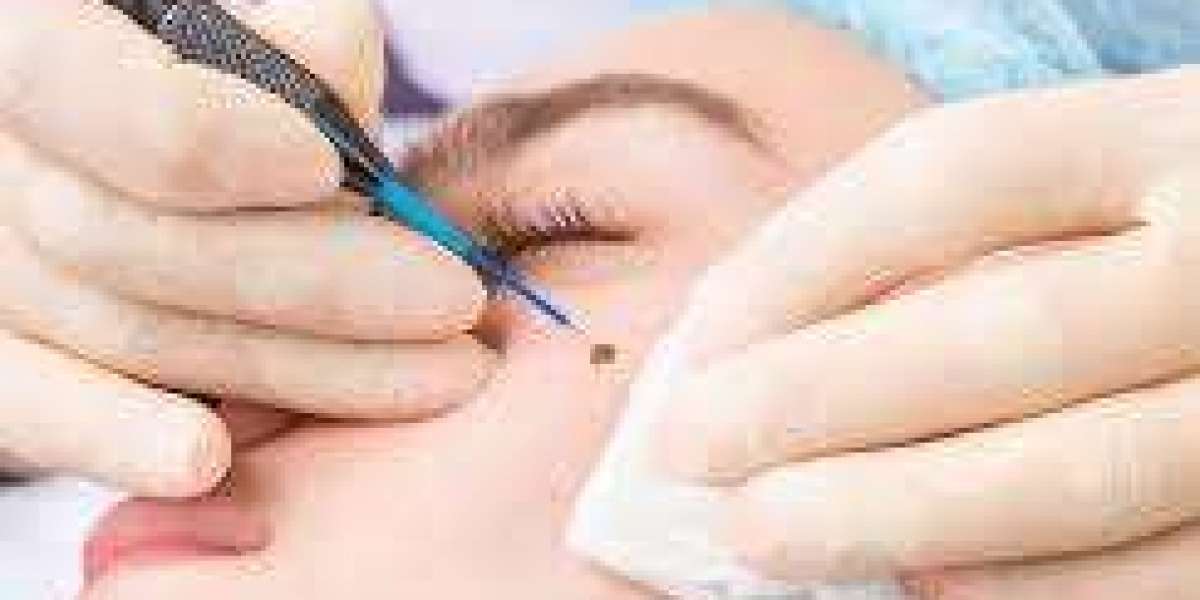 Moles Removal in Dubai: Clear Skin with Advanced Techniques