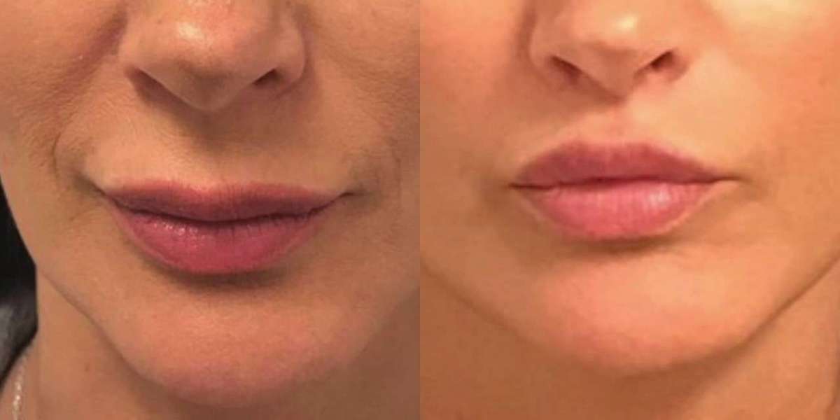 Your Lip Lift Recovery Timeline: What to Expect Week by Week