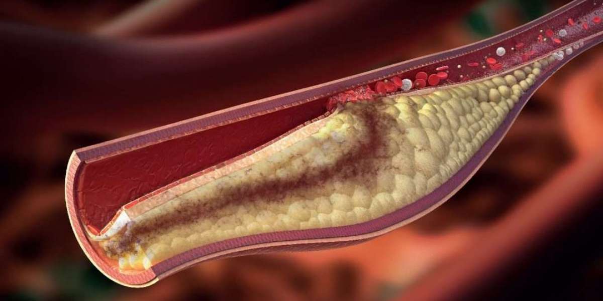 High Cholesterolemia Dubai: Foods to Eat and Avoid