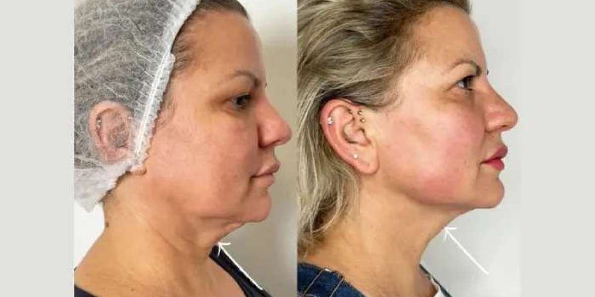 Endolift Treatment in Dubai: A Modern Alternative to Facelift Surgery