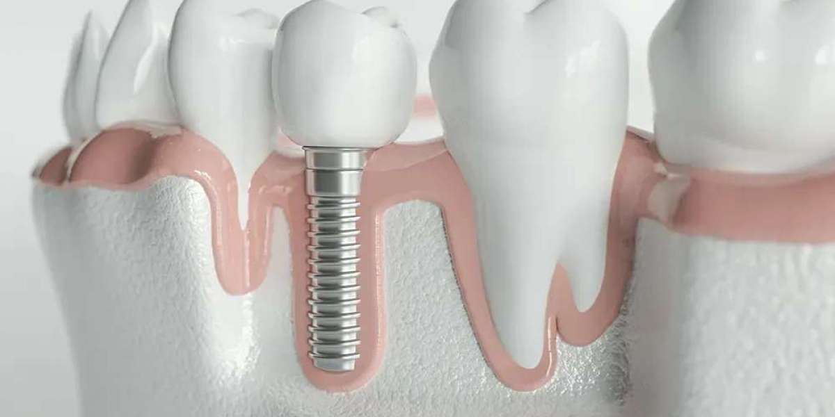 Managing Dental Pain with Affordable Root Canal Treatment Badlapur