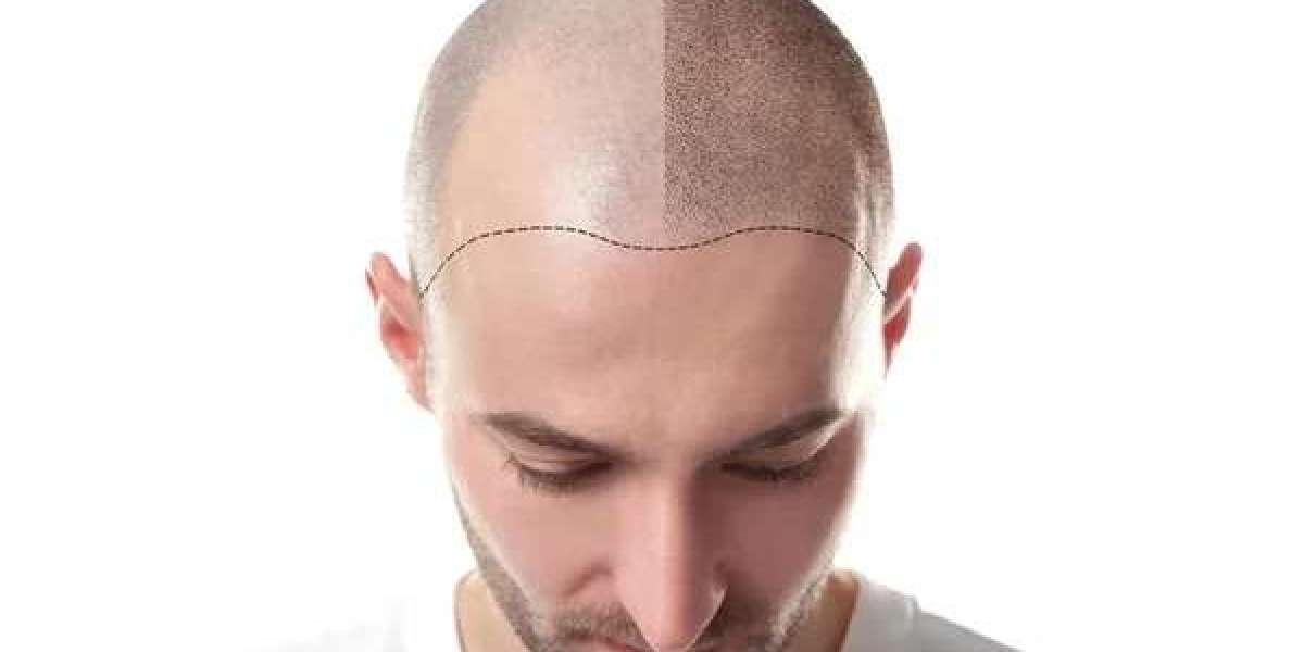 Hair Transplant for Natural Fullness at Medixo Aesthetic Clinic
