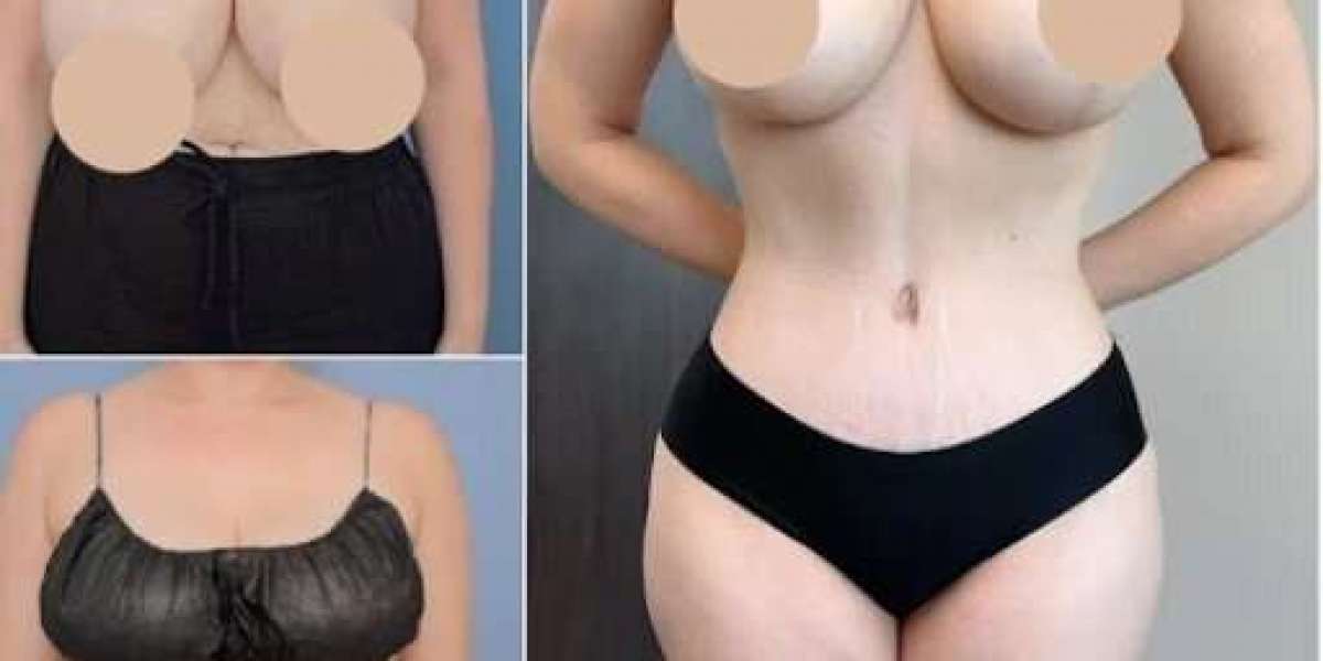 Tummy Tuck in Dubai: Transform Your Body with Confidence