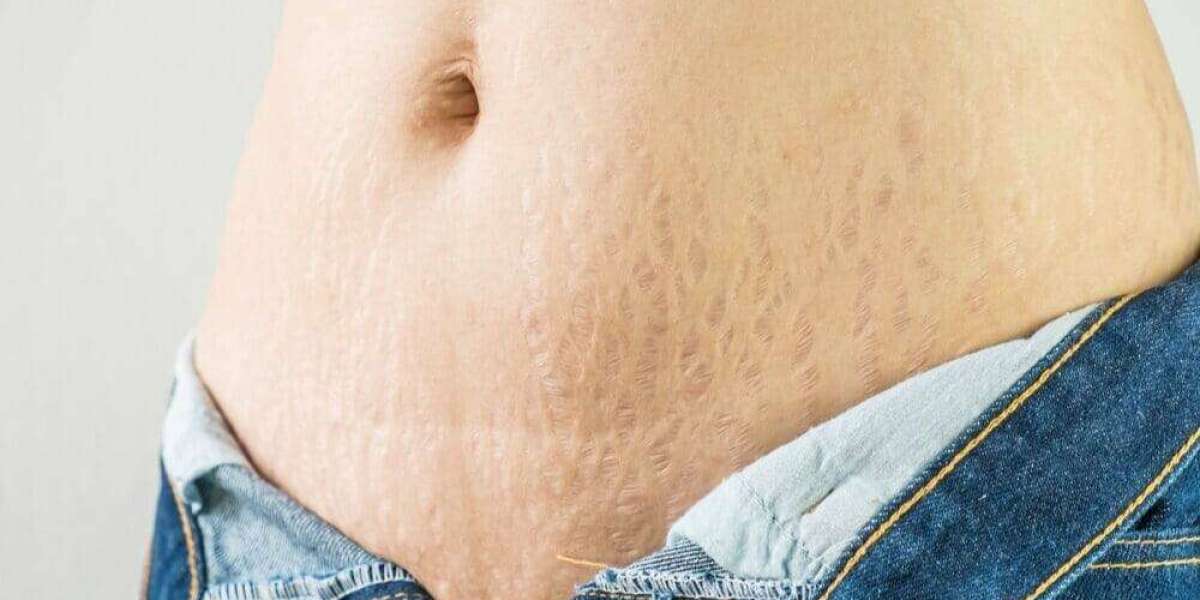 Laser Stretch Marks Treatment for Pregnancy Stretch Marks