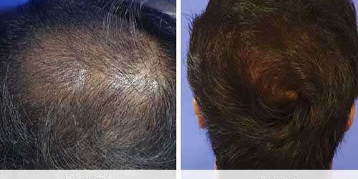 نتائج زراعة الشعر قبل وبعد عام كامل من الإجراء