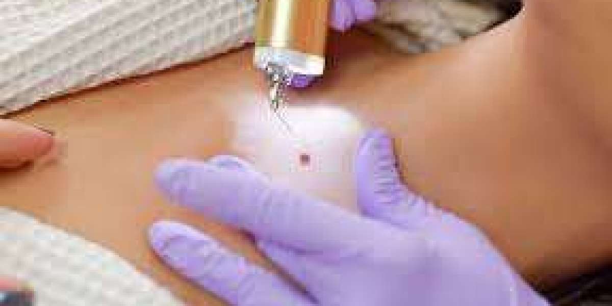 Laser Wart Removal for Plantar Warts in Dubai: Safe and Modern Treatment Guide