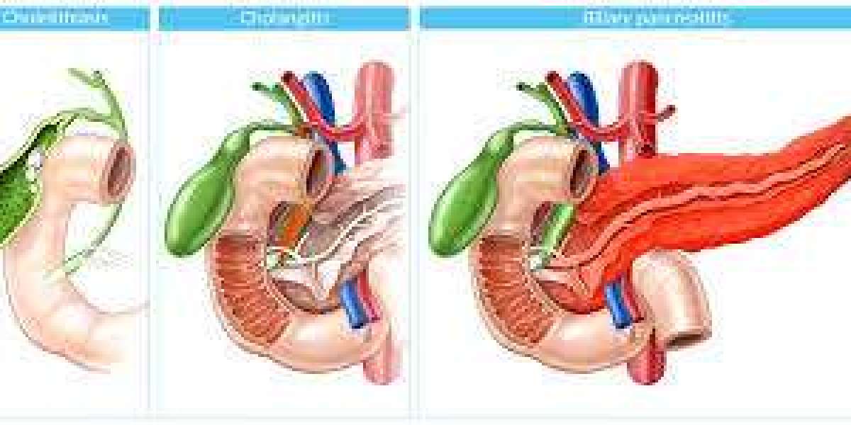 Safe and Effective Biliary Tract and Liver Surgery in Dubai Explained
