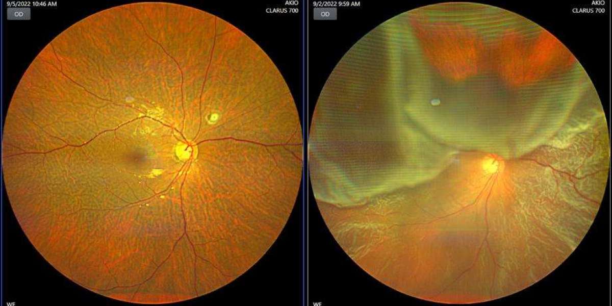 Finding the Right Retina Specialist in Delhi for Clear Vision