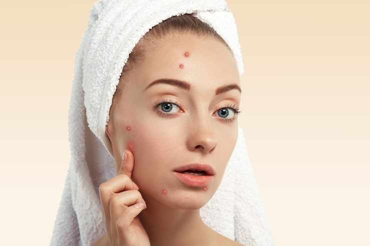 Best Acne Treatment in Gurgaon: Effective Solutions for Clear Skin