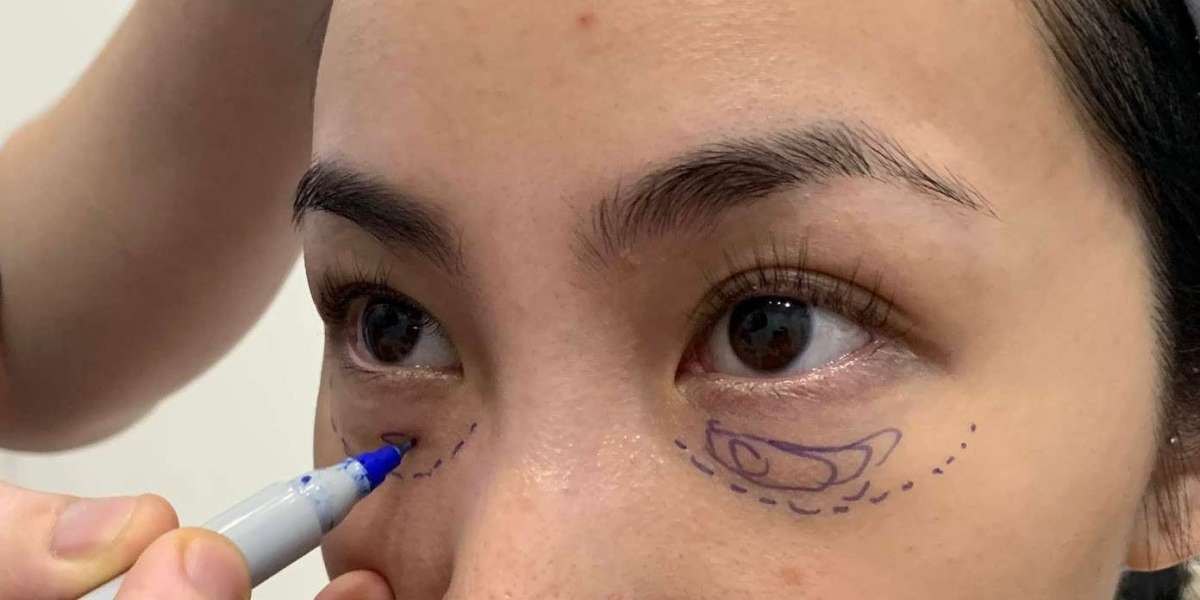 Eye Bag Removal in Islamabad – Complete Simple Blog (Enfield Royal Clinic)