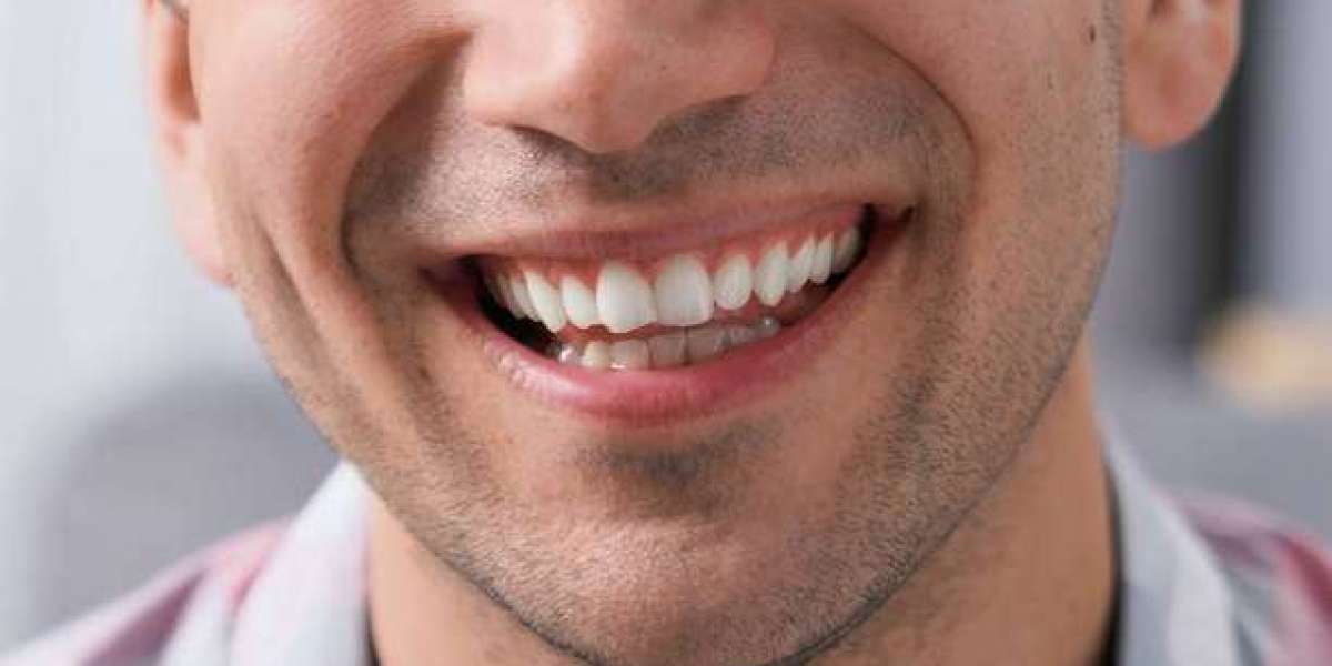 Hollywood Smile in Islamabad: Complete Guide to a Celebrity-Style Smile Transformation
