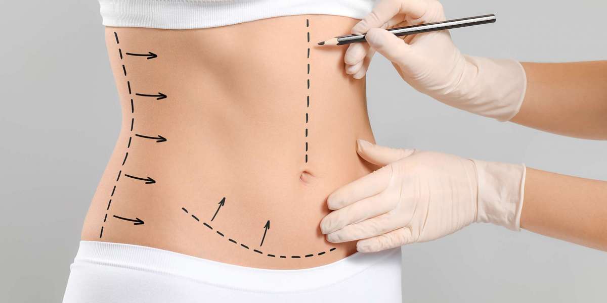 How Liposuction Can Boost Your Confidence and Body Image