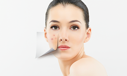 Scar Reduction Treatments in Ahmedabad | Acne Scar Treatment