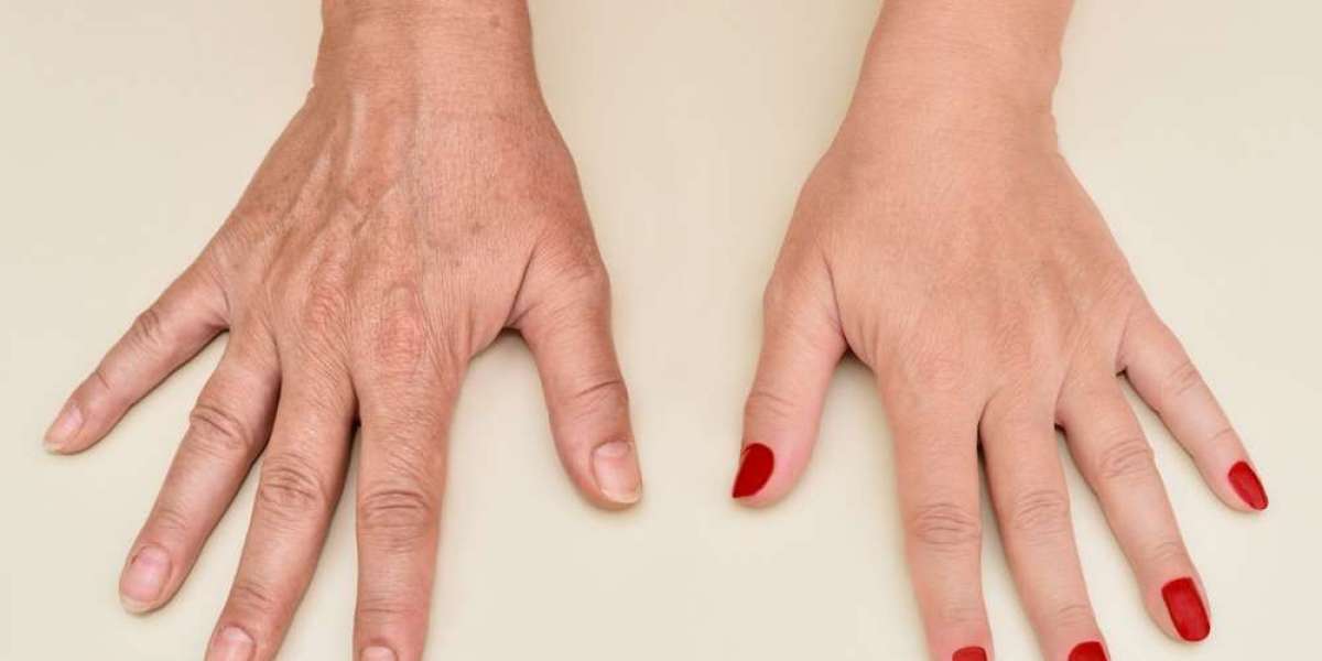 Hand Rejuvenation Secrets for Radiance and Youthfulness