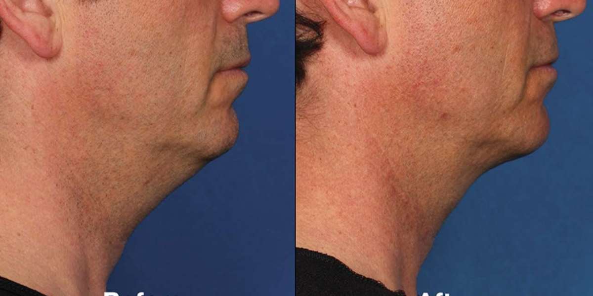 Chin Reduction Myths vs. Facts: What You Really Need to Know