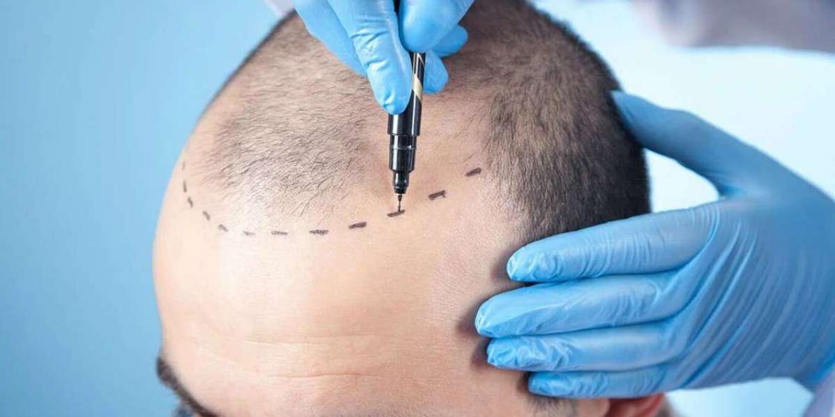 Eligibility criteria for hair transplant in Riyadh