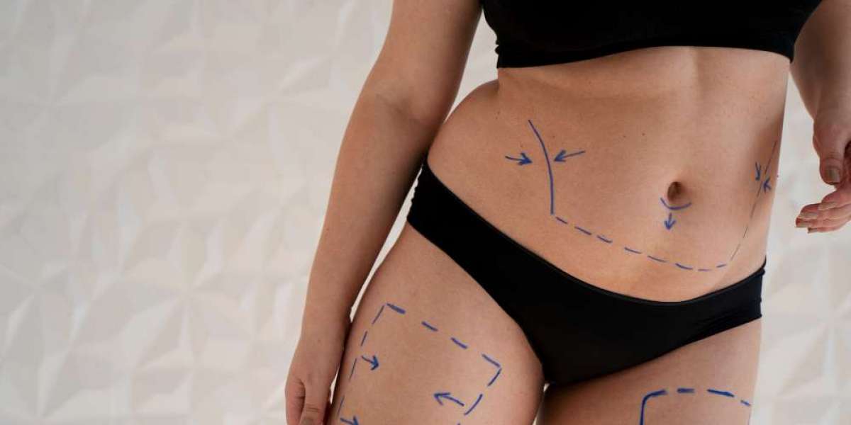 Liposuction in Dubai: Recovery Timeline and Aftercare Tips