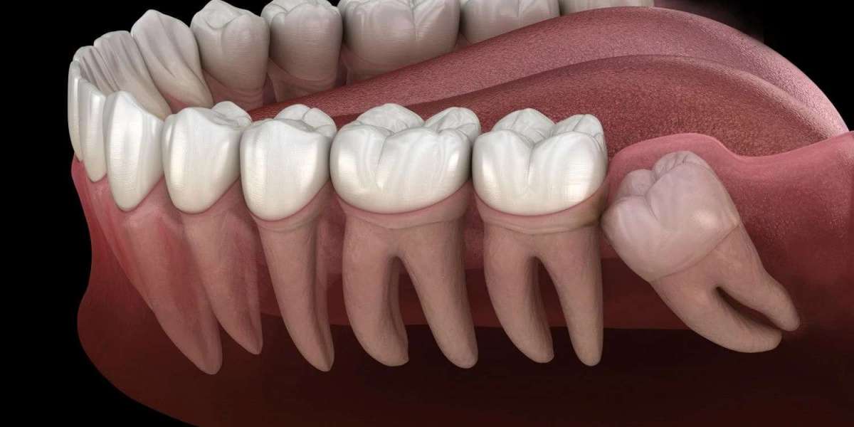 Understanding the Process of Wisdom Tooth Removal in Wanowrie