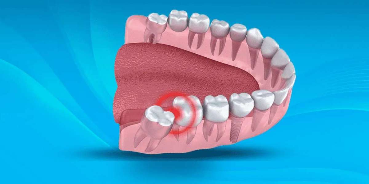 How Long Does Wisdom Tooth Removal Take? Recovery Timeline Explained