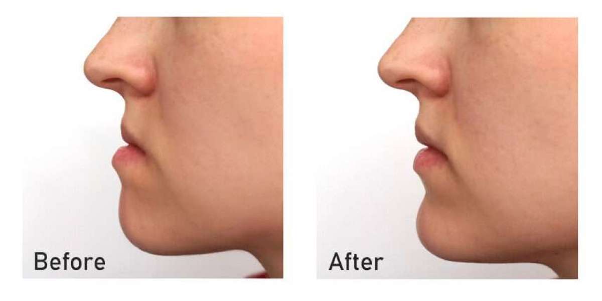 Minimally Invasive Jaw Surgery Options in Islamabad
