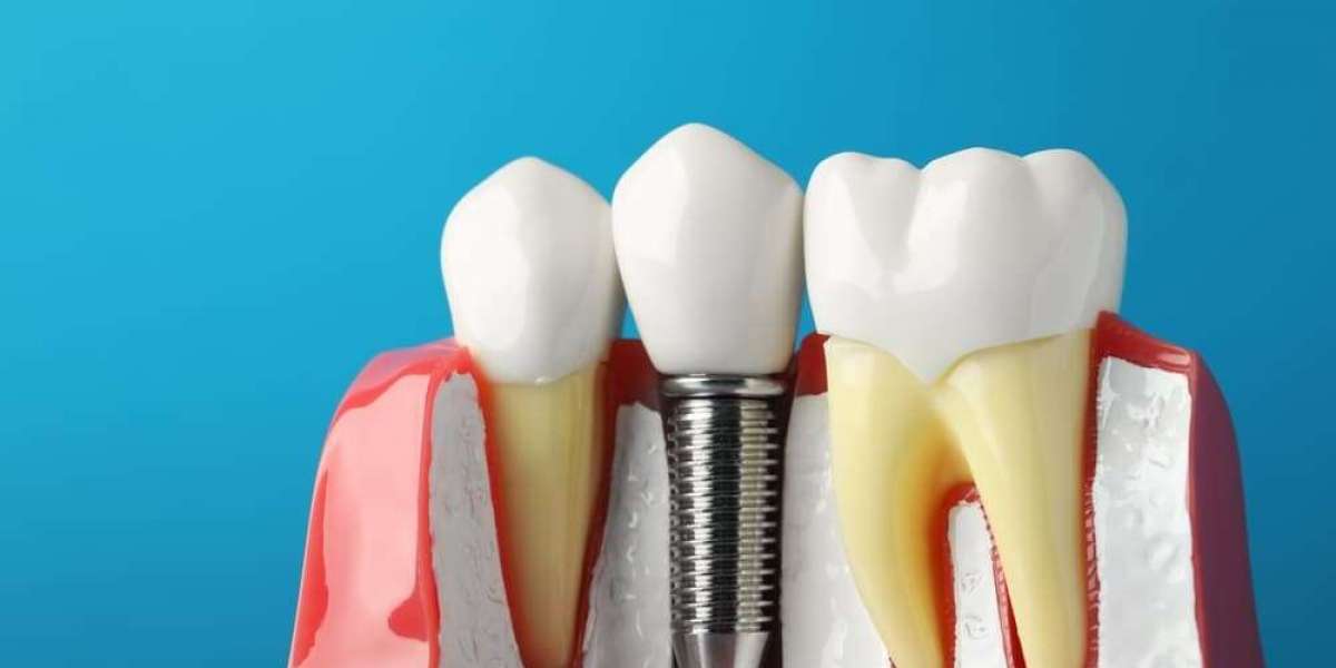 What Are Dental Implants? Cost, Procedure & Benefits Explained