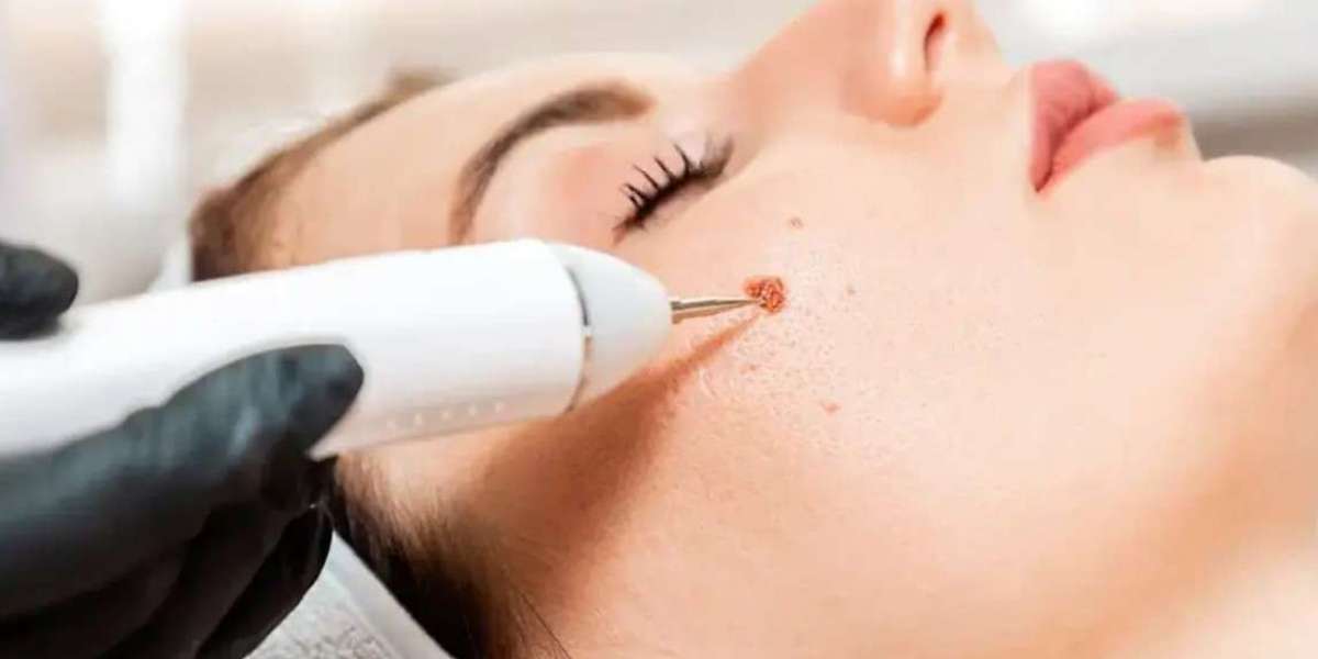 Removing flat moles vs raised moles differences