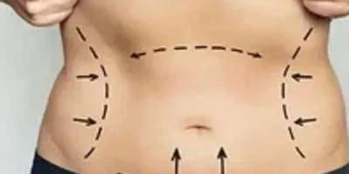 Abdominoplasty (Tummy Tuck) – Extra Useful Information