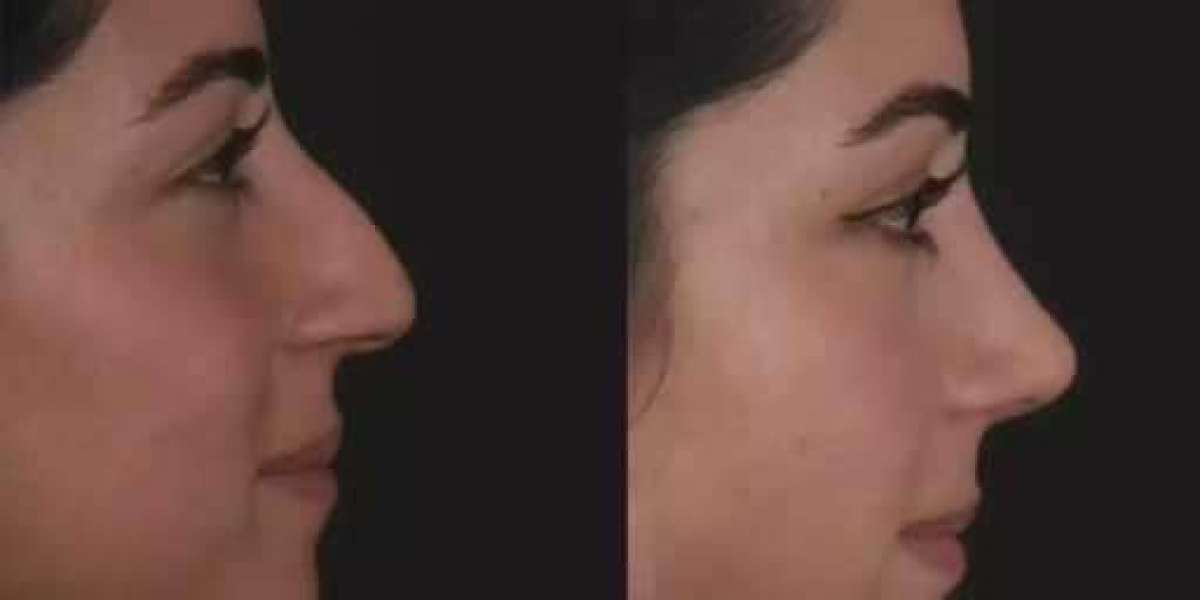 Best Septoplasty Surgeon in Dubai for Modern Surgical Methods