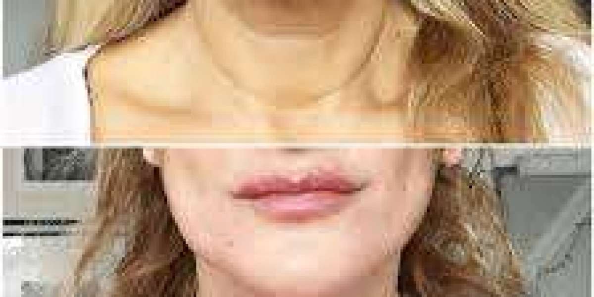 Neck Lift Surgery in Dubai for Natural Neck Rejuvenation and Youthful Definition