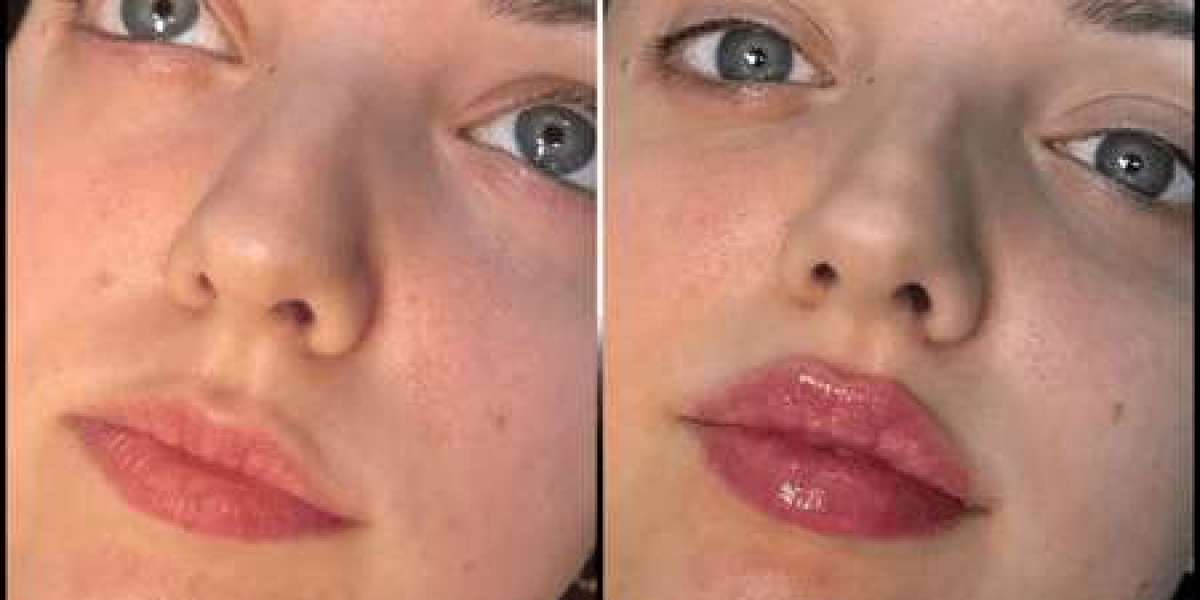 Everything You Need to Know About the Procedure for Fillers in Dubai